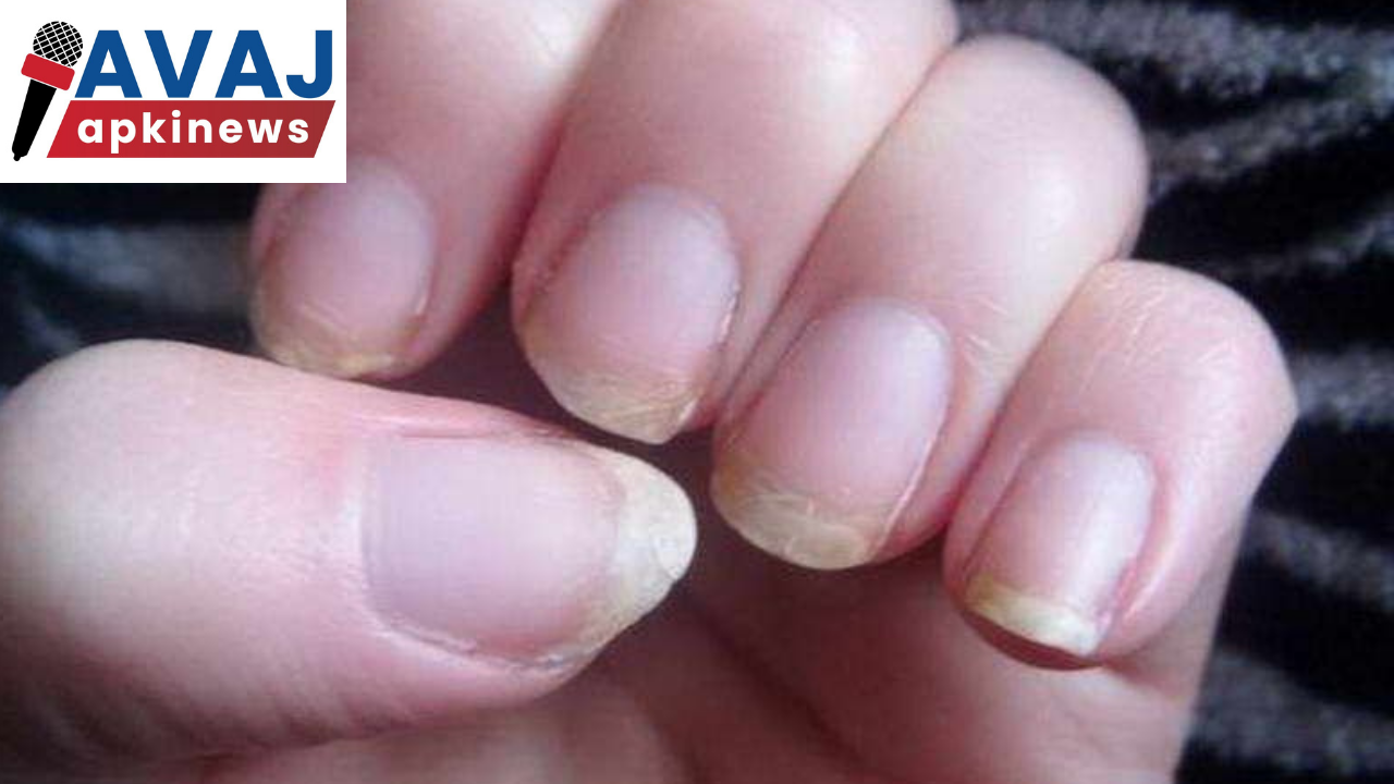 nail-deficiency-here-s-why-you-get-white-patches-on-nails-avaj-apki-news